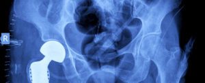 Risks Associated with DePuy Hip Systems