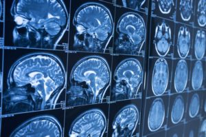 Representing All Victims of Brain Injuries in Boston, MA