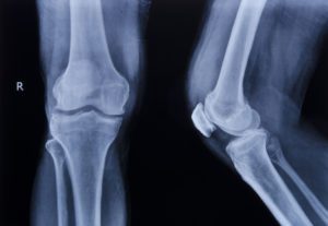 Bone and Ligament Injury